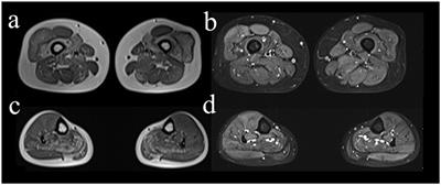 A female case report of LGMD2B with compound heterozygous mutations of the DYSF gene and asymptomatic mutation of the X-linked DMD gene